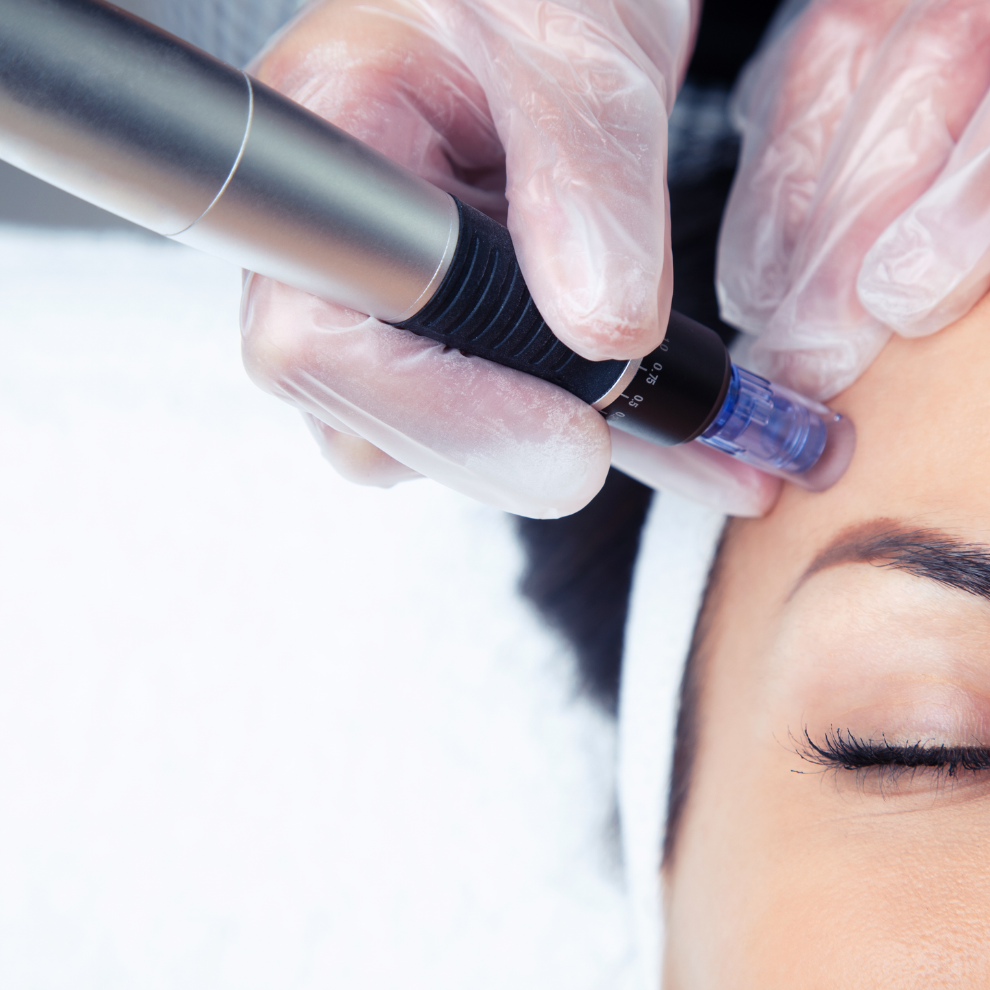 Microneedling