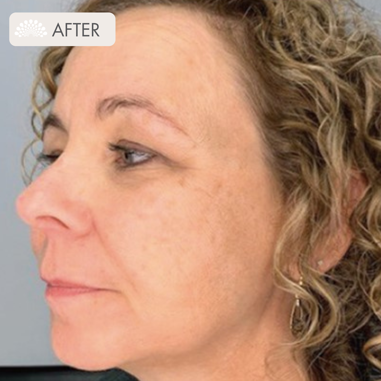 Bela MD Microdermabrasion