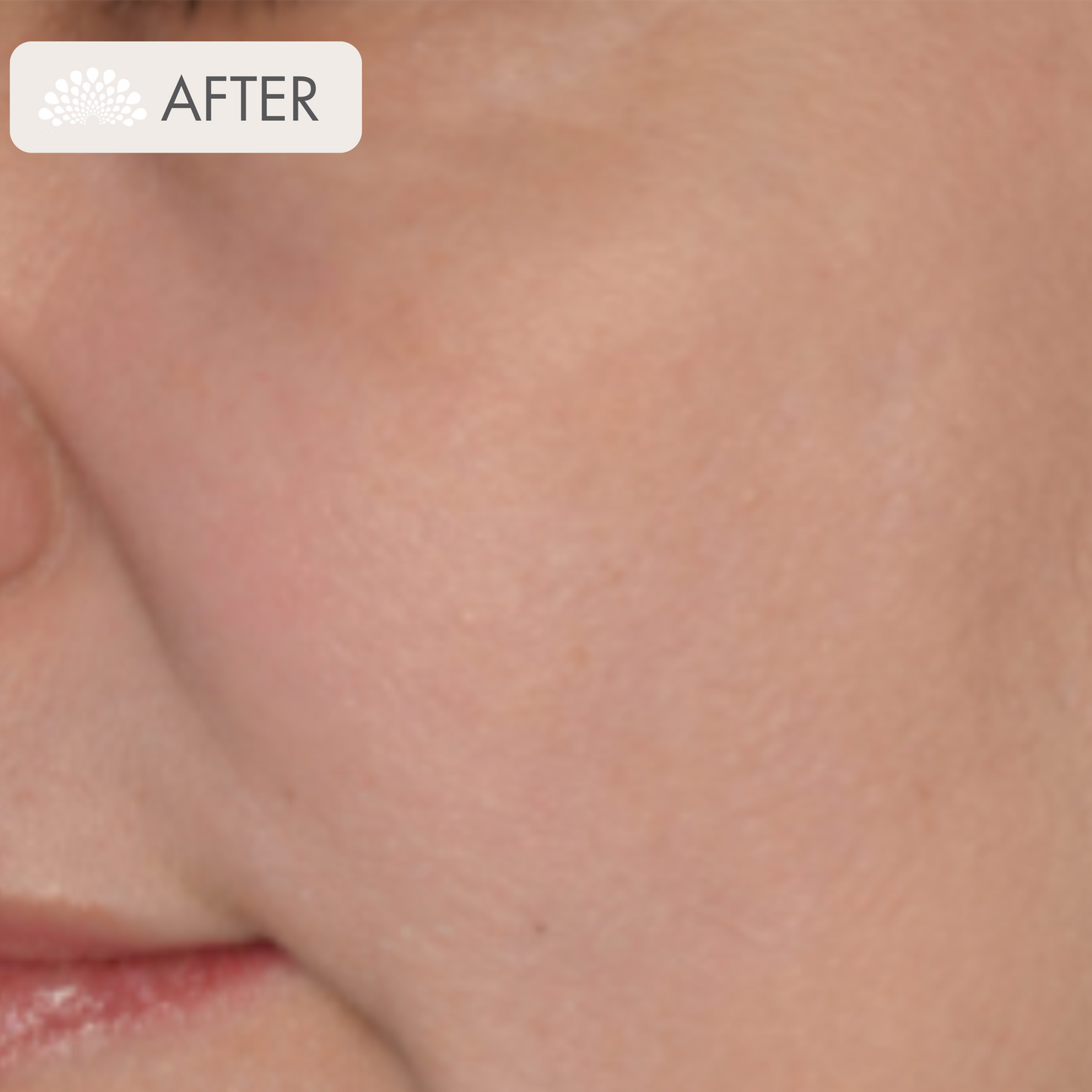 ZO Controlled Depth Blue Peel Package