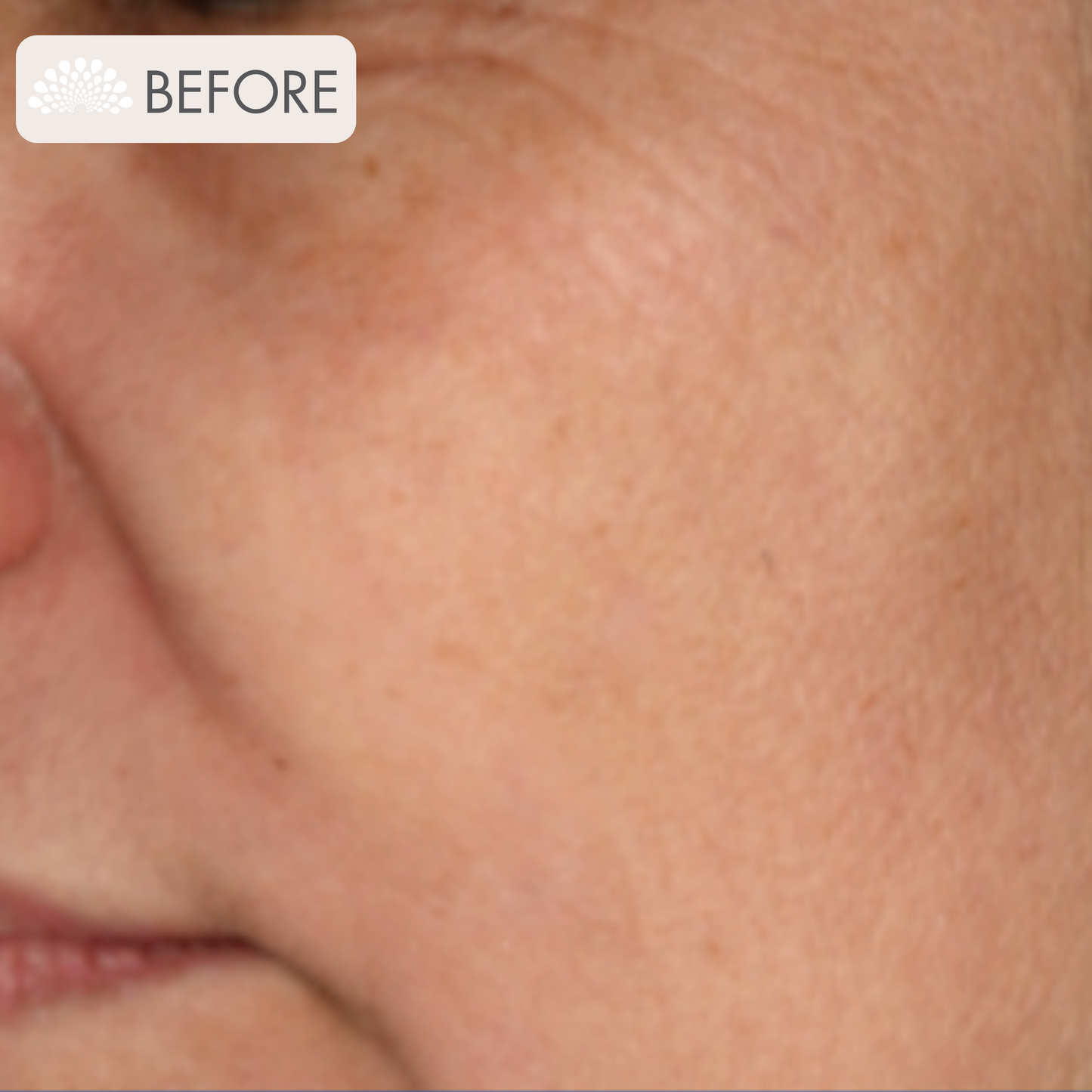 ZO Controlled Depth Blue Peel Package