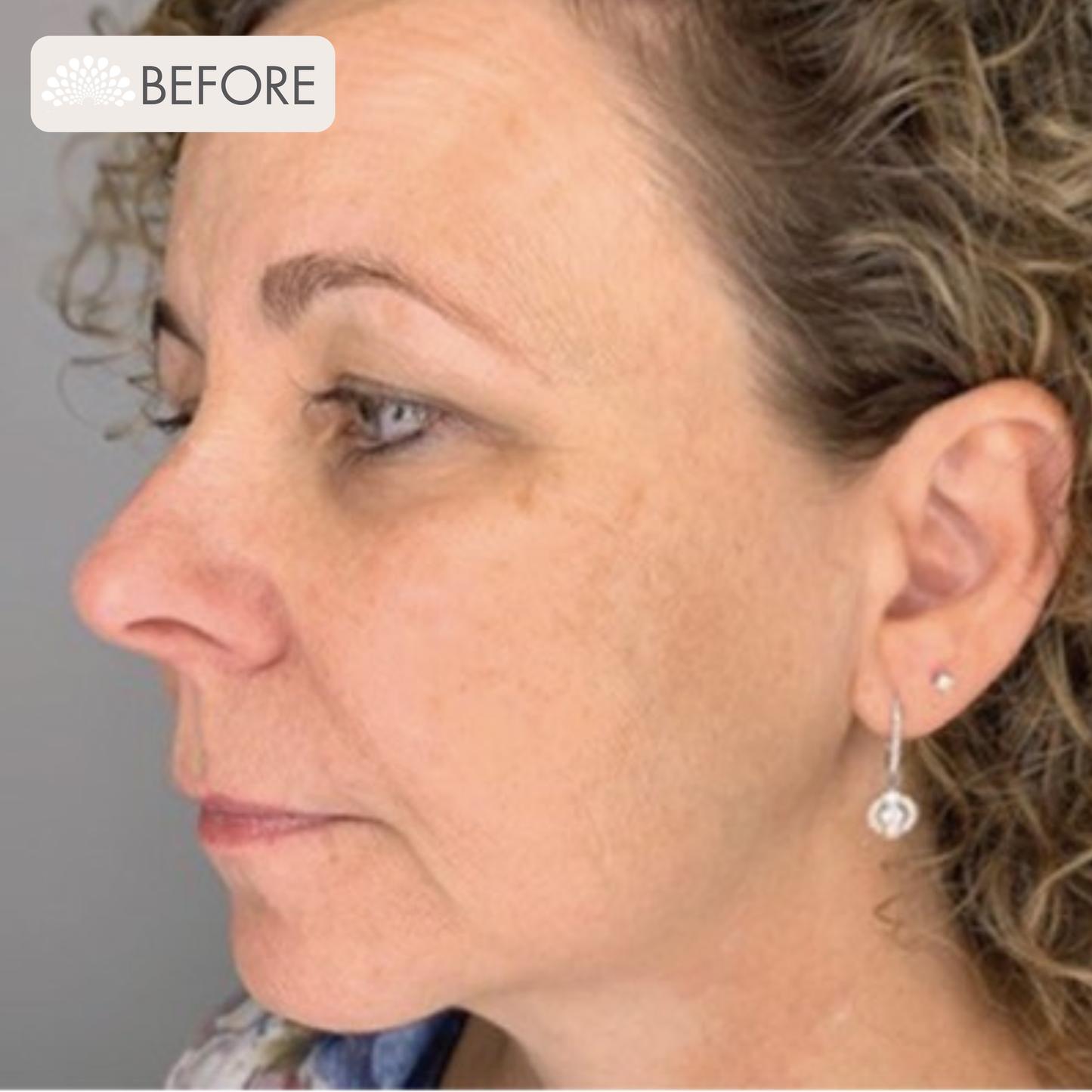 Bela MD Microdermabrasion