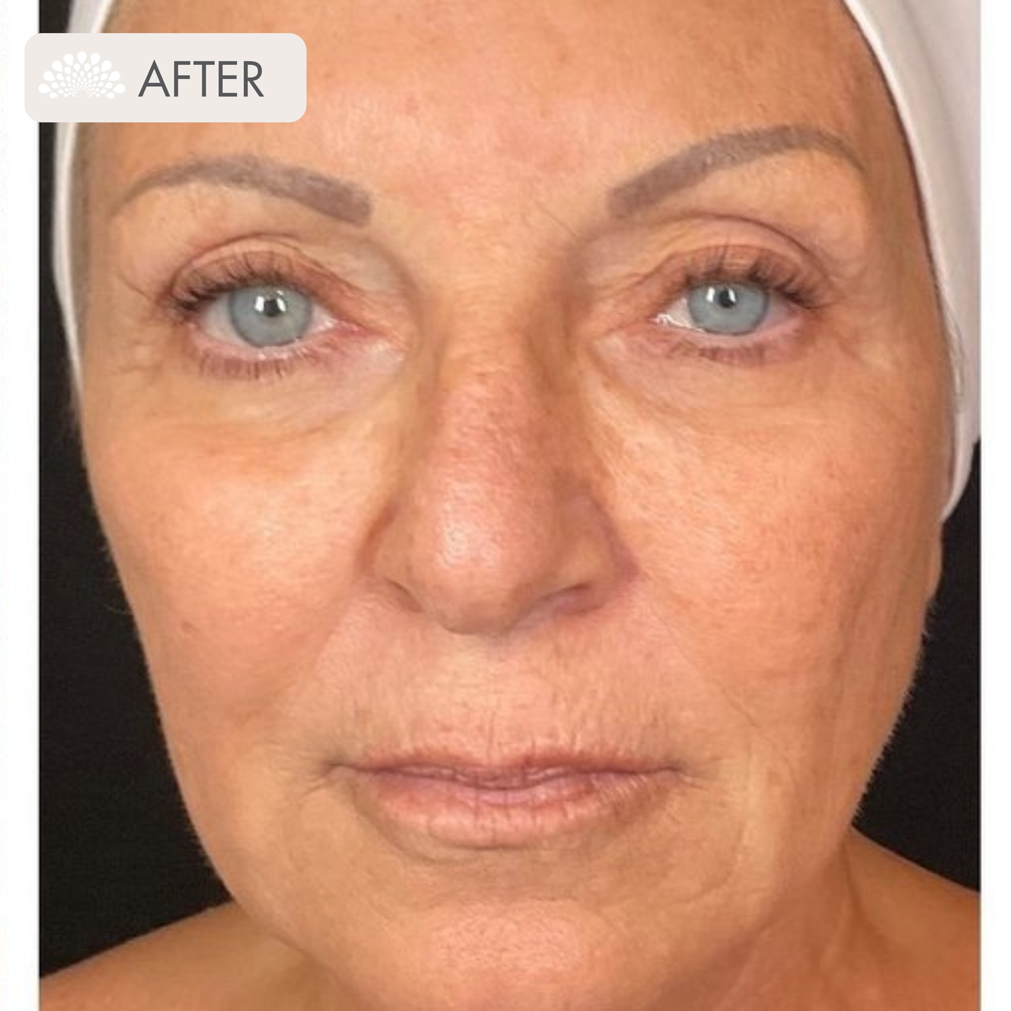 Thermage  + Tixel Package