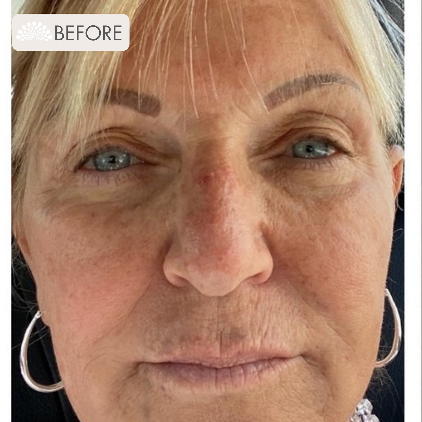 Thermage  + Tixel Package